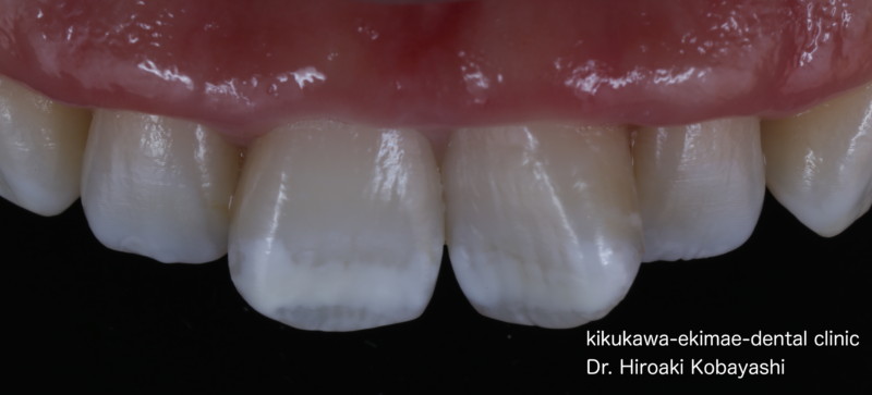 削らずにホワイトスポット 歯の白濁 の改善 菊川駅前歯科 Kobayashi Dental Office のブログ 削らずにホワイトスポット 歯の白濁 の改善 菊川駅前歯科 Kobayashi Dental Office のブログ