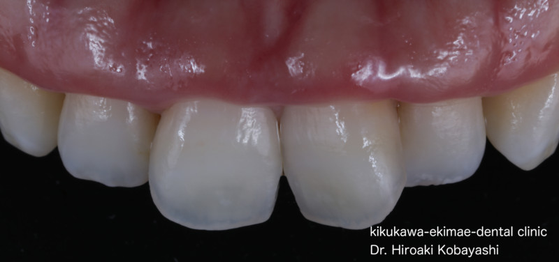 削らずにホワイトスポット 歯の白濁 の改善 菊川駅前歯科 Kobayashi Dental Office のブログ 削らずにホワイトスポット 歯の白濁 の改善 菊川駅前歯科 Kobayashi Dental Office のブログ