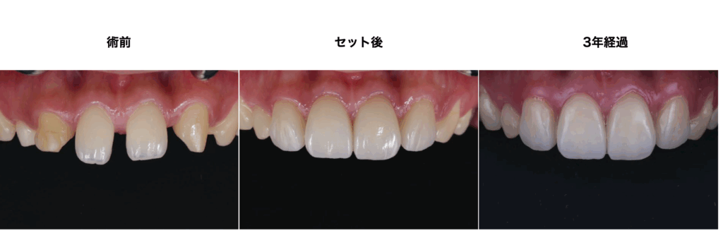セラミック矯正治療の３年後