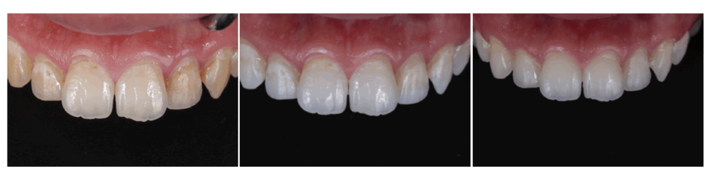 削らずに白い歯を取り戻す——Iconとホワイトニングでホワイトスポット・ブラウンスポットを自然に改善