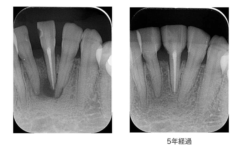 隣の歯に跨る大きな骨の欠損があった歯が、1歯の精密根管治療で5年後に完全再生した症例