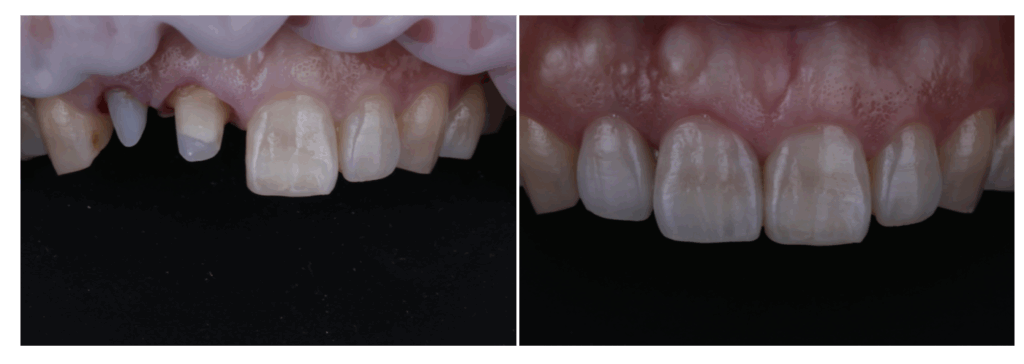 【症例紹介】右上の前歯を精密根管治療とジルコニアクラウンで美しく再生