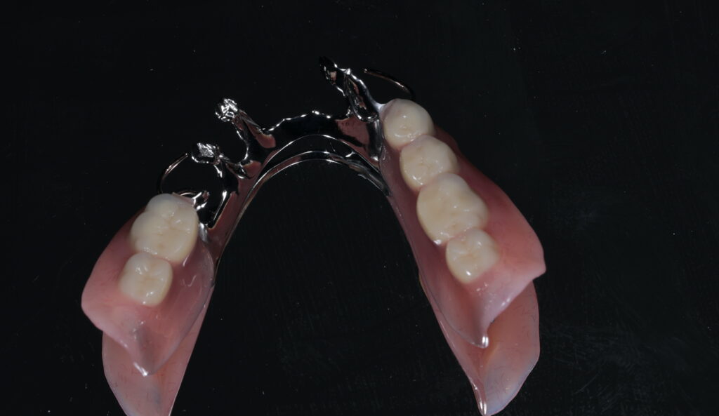 なぜ保険の入れ歯は合わないのか？技工士不足の今こそ“金属床義歯”を選ぶべき理由