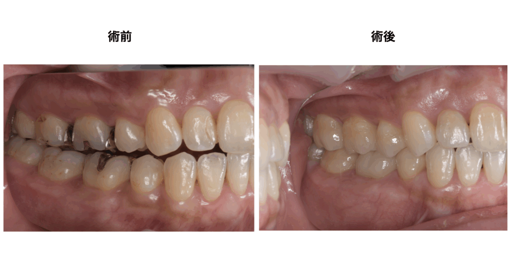**マウスピース矯正で“気づかないうちに”オープンバイトに…
