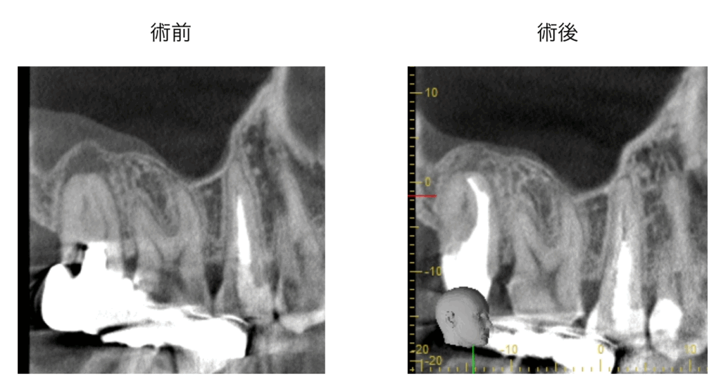 【精密根管治療で上顎洞の不調まで改善】