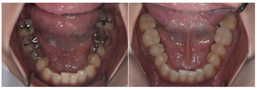 銀歯を白くする治療で失敗しないために──“接着”と“噛み合わせ”が運命を決める理由