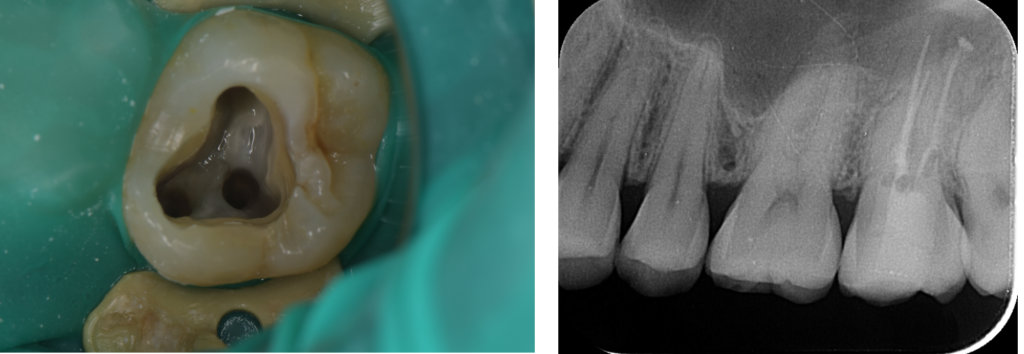 精密根管治療とは？歯を残すために本当に大切な選択