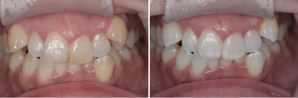 【症例紹介】1ヶ月半のホームホワイトニングで自然に白くなったケース