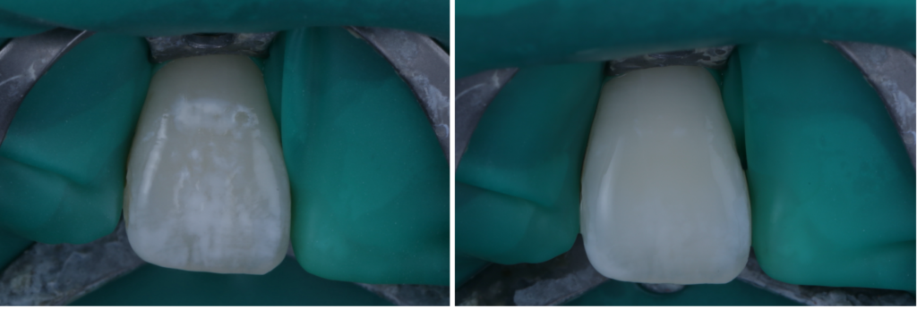 歯の白いシミが気になる方へ|削らずに治すICON治療とは?【菊川駅前歯科】