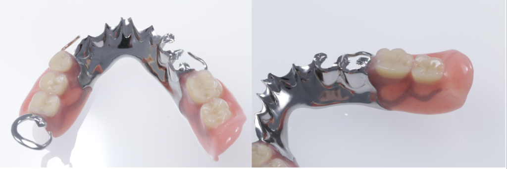 自費で義歯（入れ歯）を作るメリットとは？