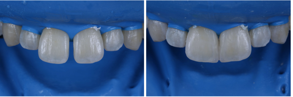 前歯の隙間をダイレクトボンディングで改善した症例｜菊川駅前歯科で行う審美治療