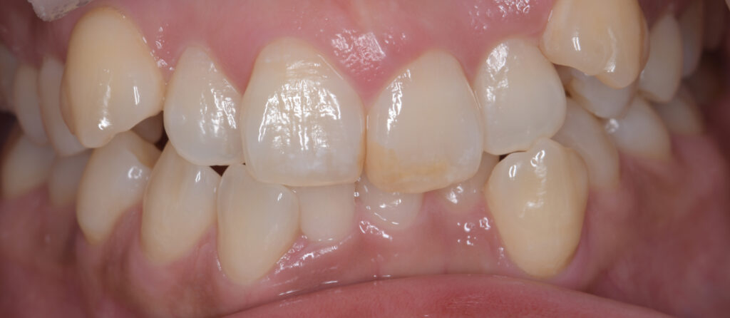 ブラウンスポットはホームホワイトニングで、白濁はICONで改善した症例のご紹介