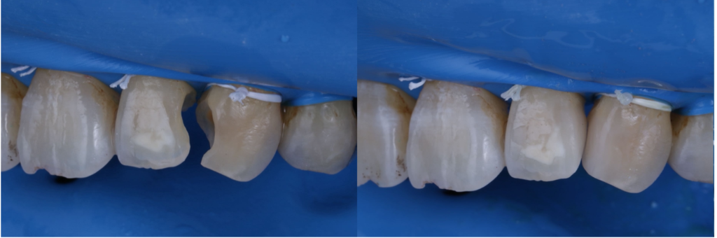 保険のCR処置のリスクと