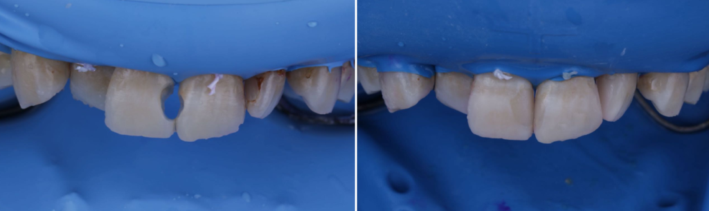 ダイレクトボンディングによる虫歯治療のメリット