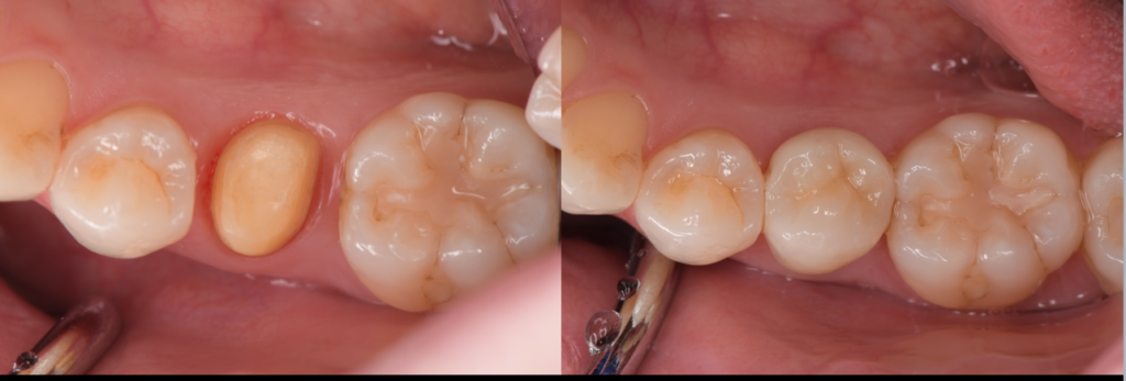 セラミック修復