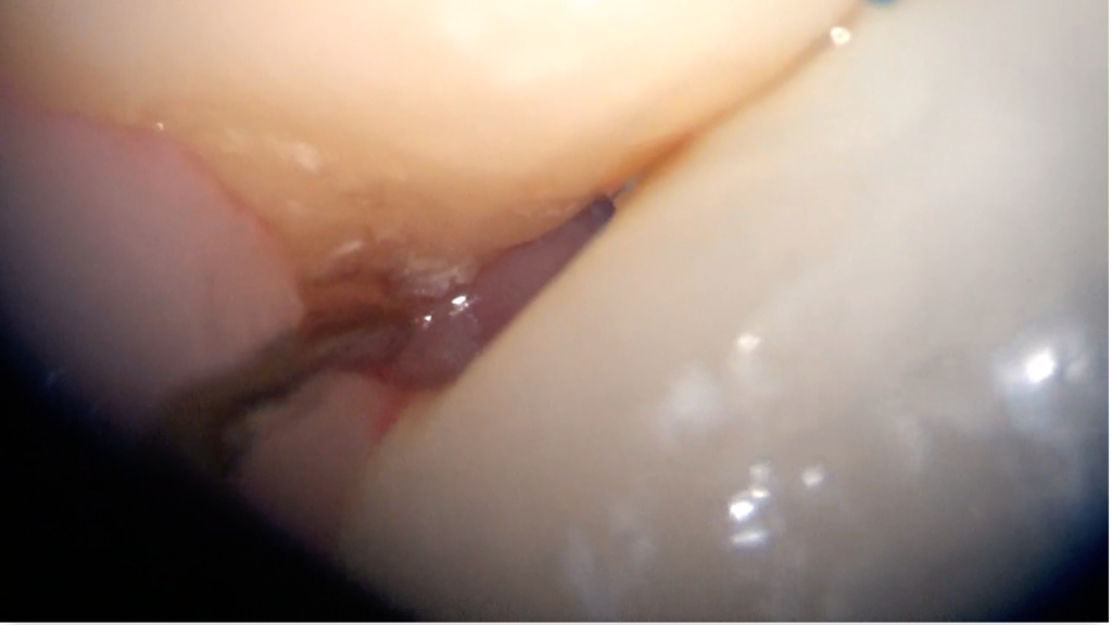 顕微鏡(マイクロスコープ)で歯石を取るメリット