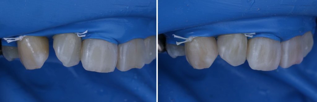 ダイレクトボンディングで後悔したくない方へ