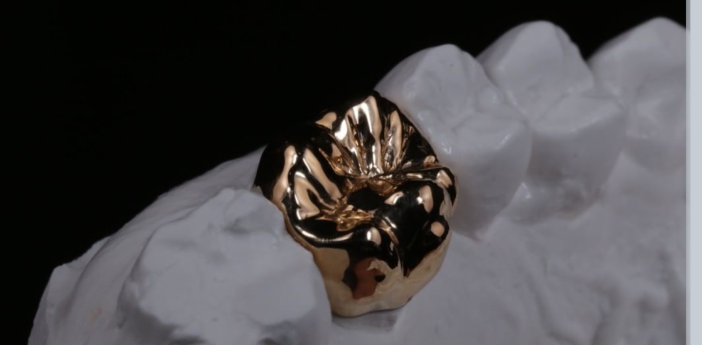 ゴールド修復という“本当に歯を守る治療”をご存じですか?