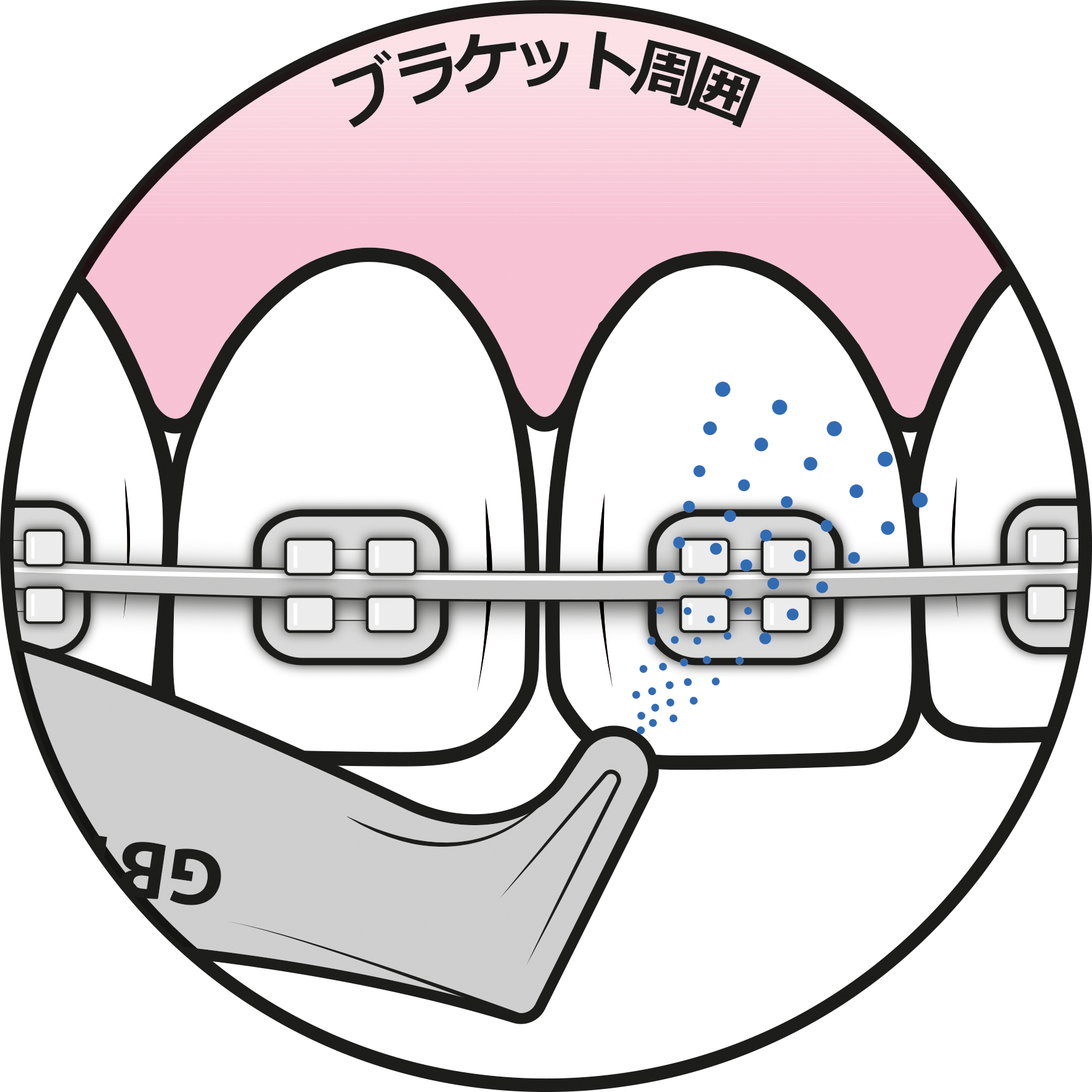 矯正装置の維持