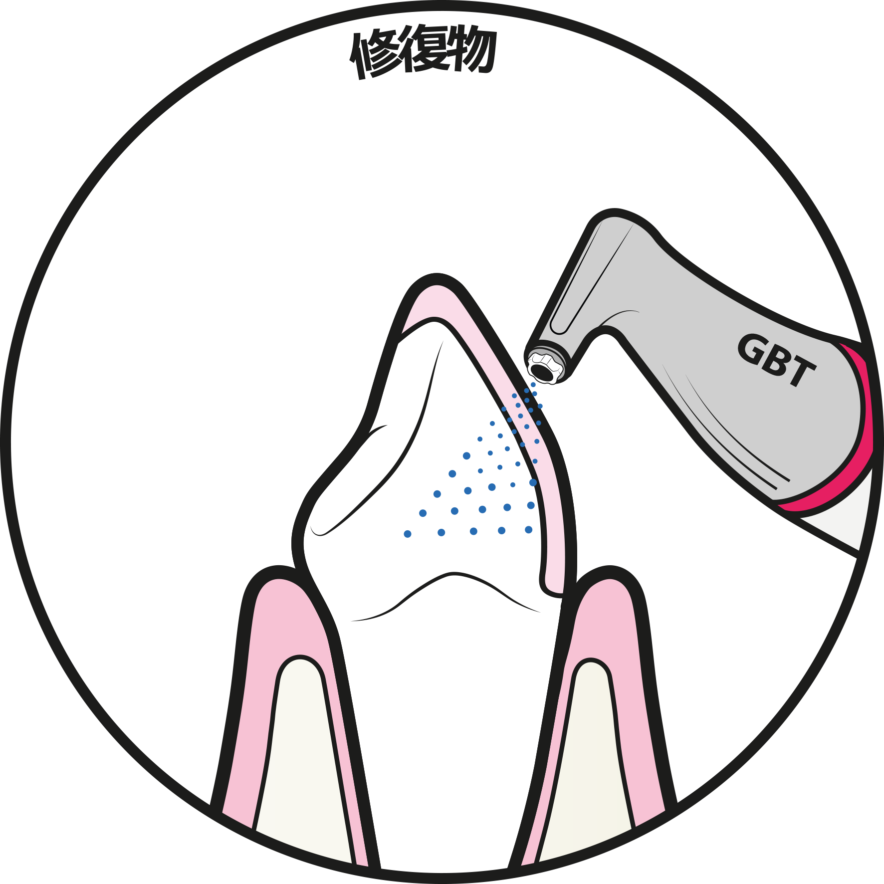 審美修復物の保全