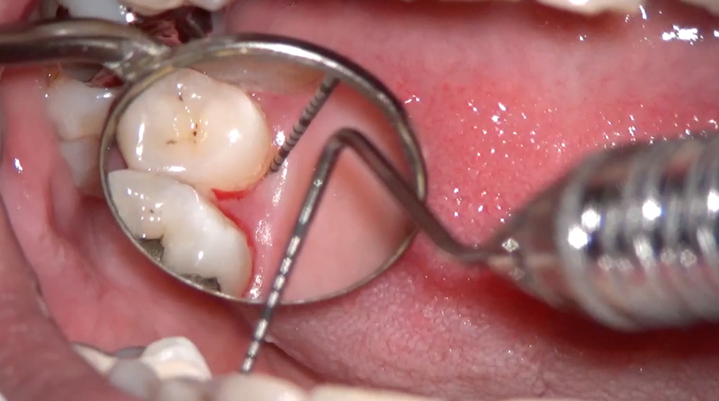 歯周精密検査で「出血・ポケットが深い」と言われた方へ