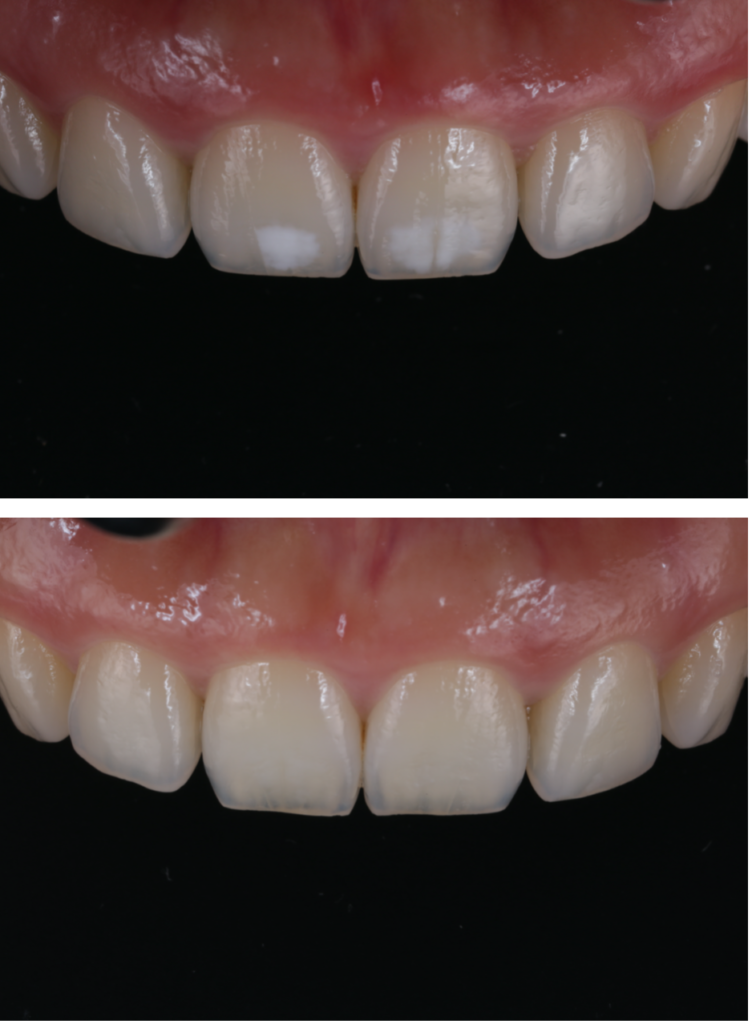 歯を削らず白く】ICON（アイコン）治療で前歯の白濁を改善｜菊川駅前歯科