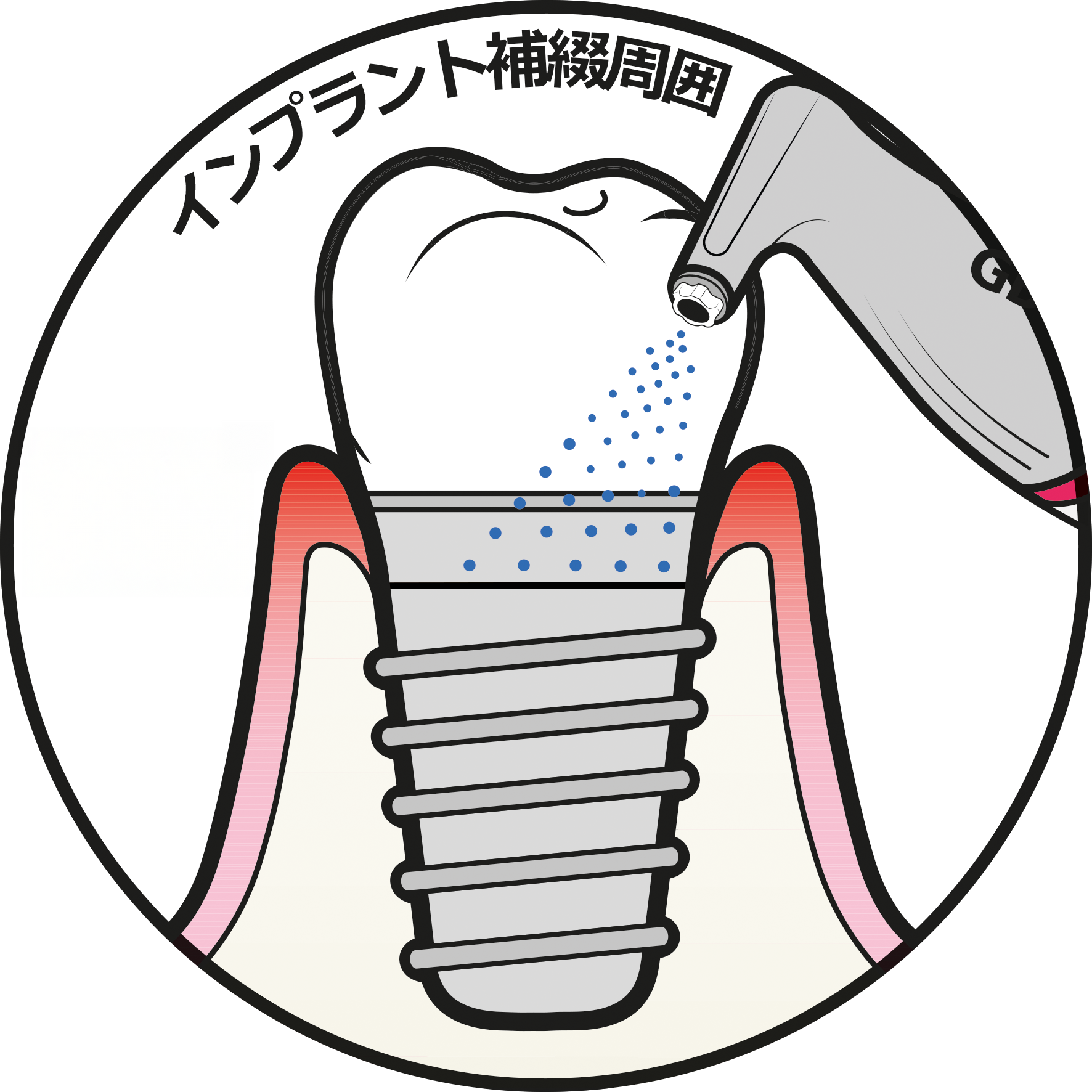 インプラント周囲炎の治療