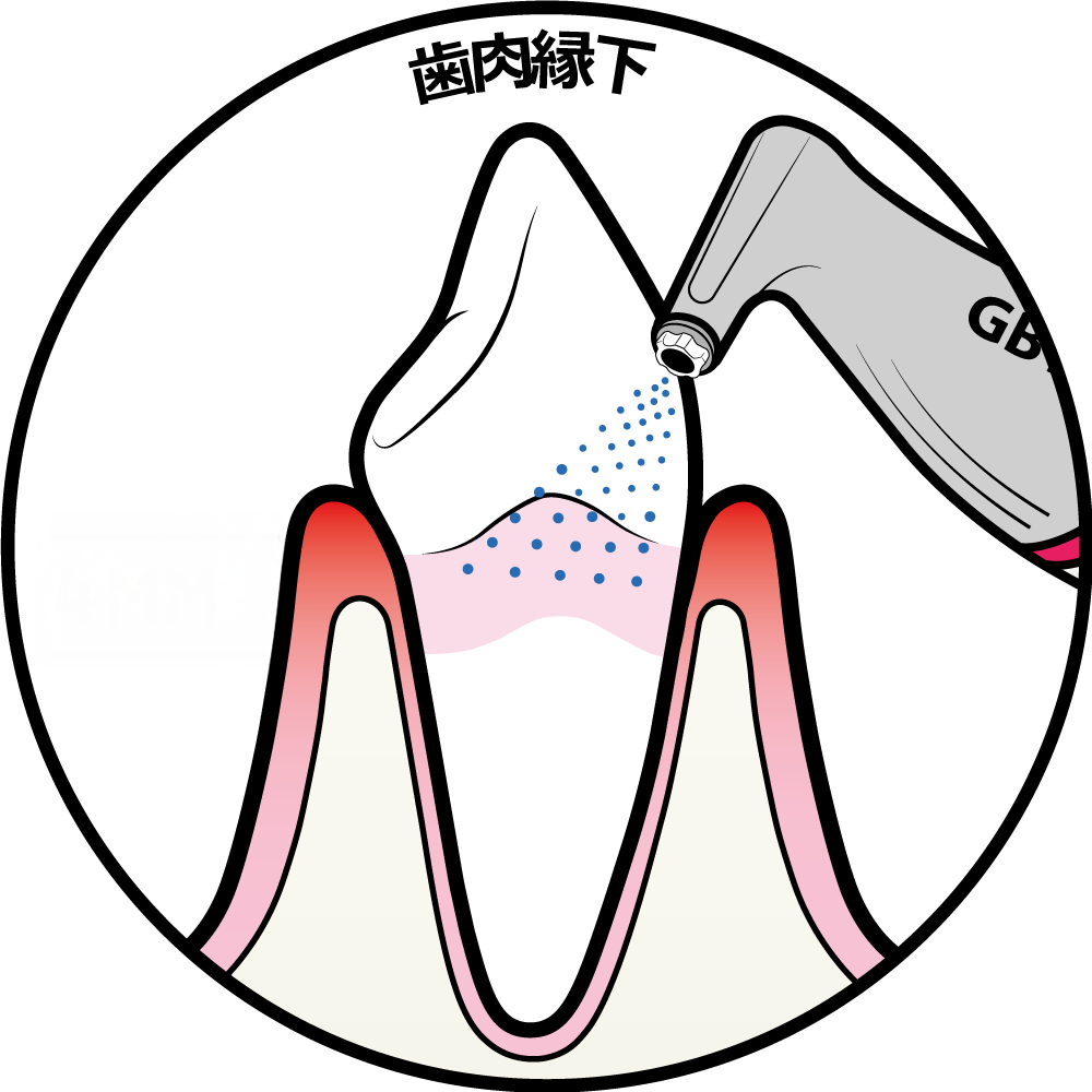 歯周病の治療