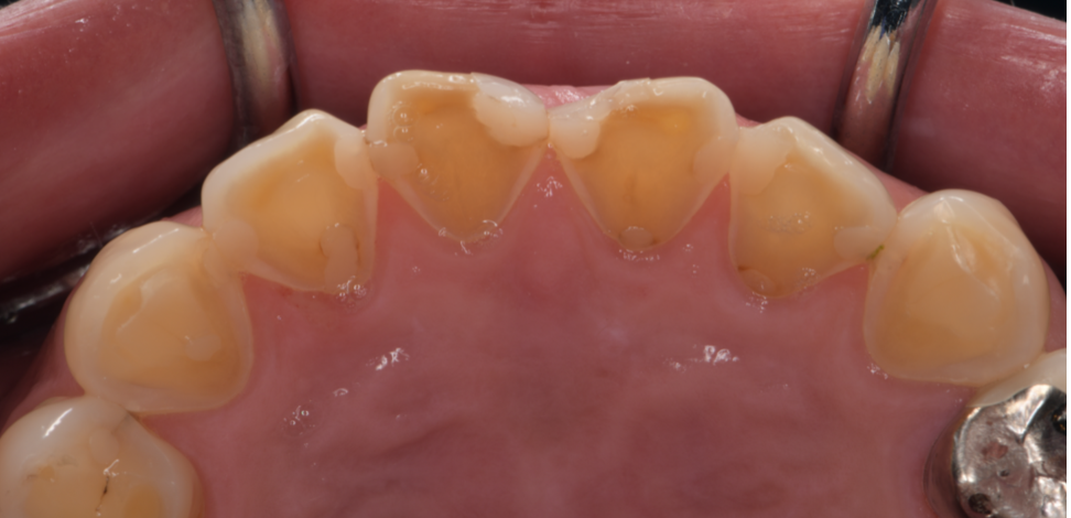 健康意識が高い人」ほど危ない?歯が溶ける“酸蝕症”と、それを食い止めるセラミック修復の真実