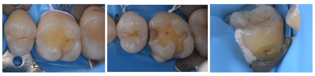 歯の寿命を延ばす「削らない治療」とは？ダイレクトボンディングが選ばれる理由