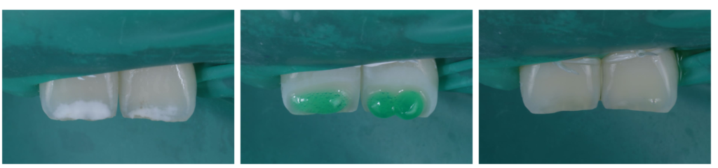 歯を削らない虫歯治療「Icon（アイコン）」とは？ホワイトスポットの悩みも解決できる最新治療を解説