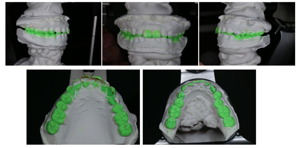 セラミックで治したのに「噛み合わせが安定しない」あなたへ