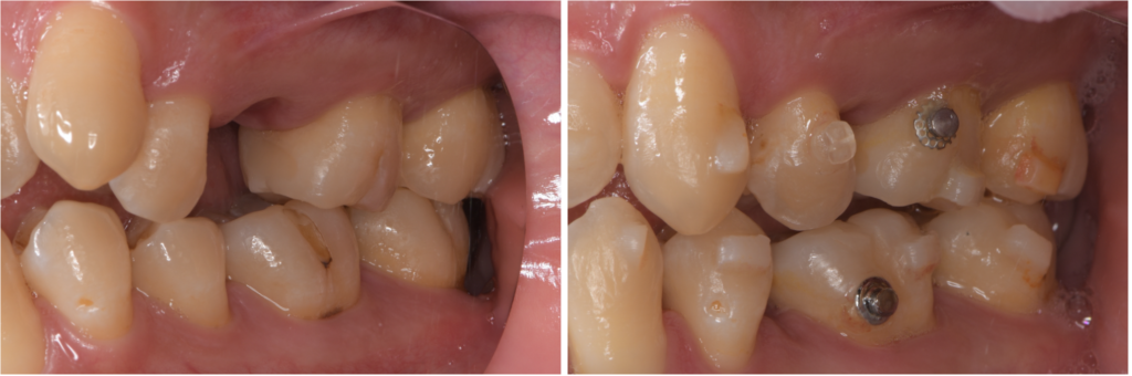 【警告】「終わらないマウスピース矯正」にご用心：広告に騙されないために