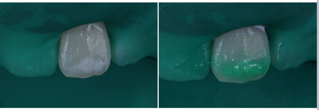 歯の白い斑点（ホワイトスポット）が気になる方へ〜ICON（アイコン）治療で削らずに自然な見た目へ〜