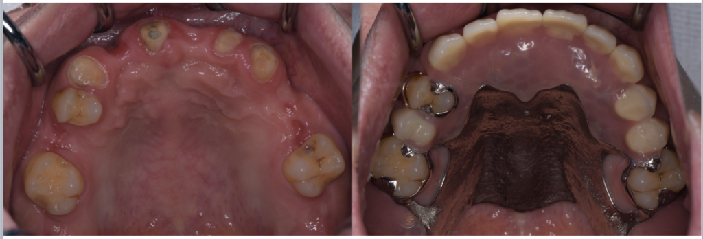 【入れ歯が合わないのはなぜ？】金属床義歯という選択肢｜菊川駅前歯科