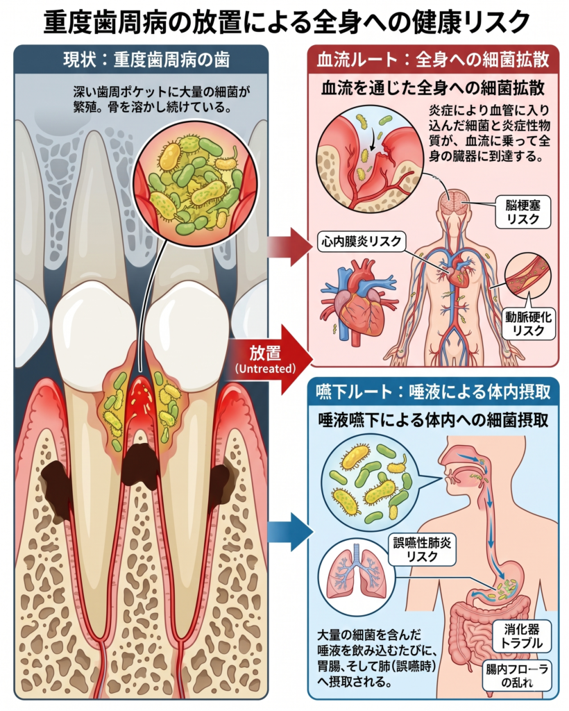 重度歯周病の放置は全身の健康を脅かす！イラストで学ぶ「静かなる殺し屋」の真実
