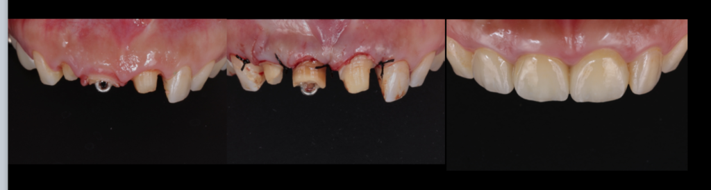 前歯のガミースマイル改善とセラミック治療｜歯を残しながら自然な美しさを目指すなら【菊川駅前歯科】