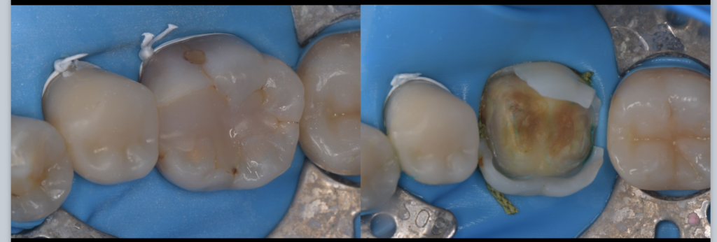 なぜ「保険のレジン」は人気なのか？（メリット）