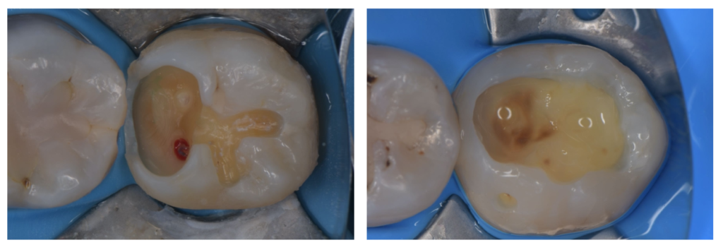 【痛くない虫歯ほど危険|見逃すと神経を失う理由とは】