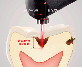 ダイアグノデント